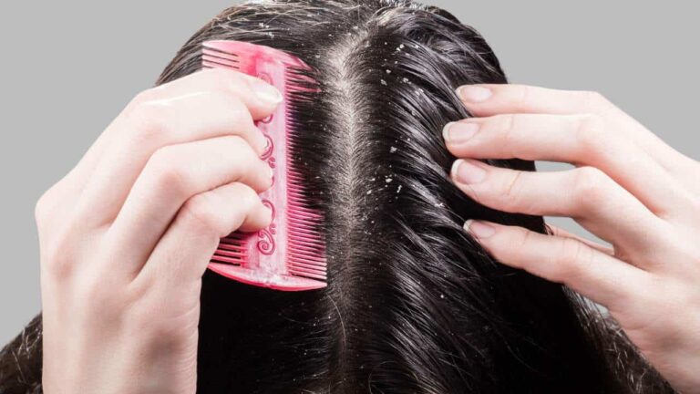 eliminar a caspa do seu cabelo