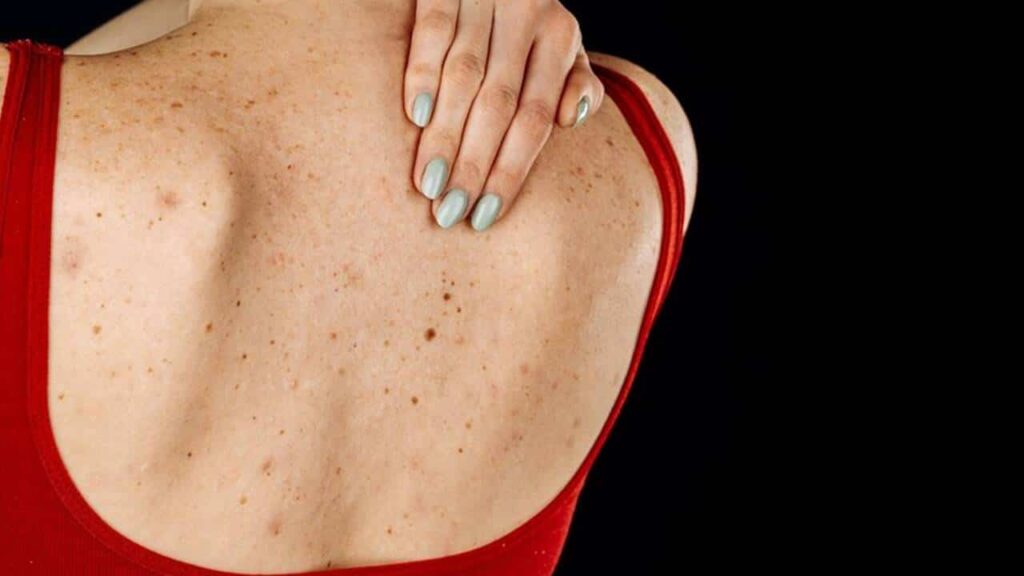 Acne nas costas? Este truque com ARROZ deixará sua pele livre de espinhas