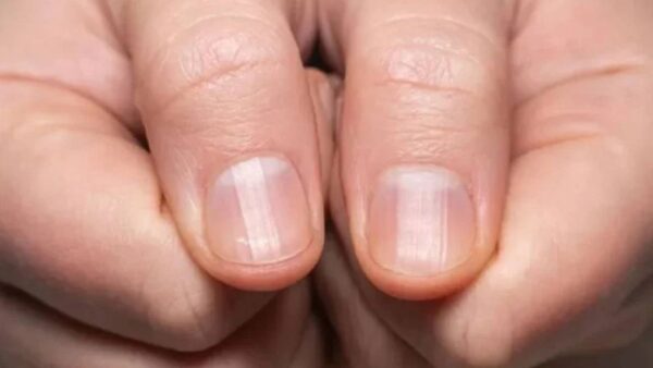 O que significa ter listras nas unhas? 