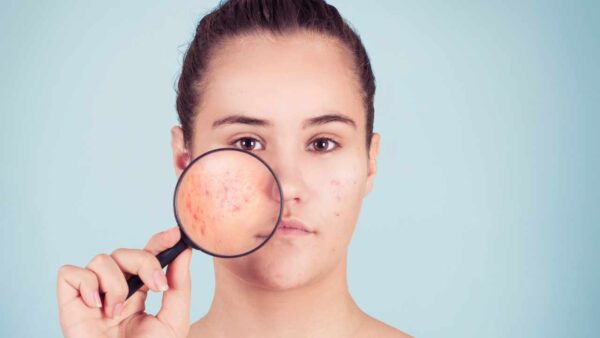 Acne de verão: o que é e como intervir